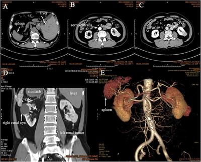 Case report: Robot-assisted laparoscopic partial nephrectomy for renal cell carcinoma in a patient with situs inversus totalis and abdominal cocoon
